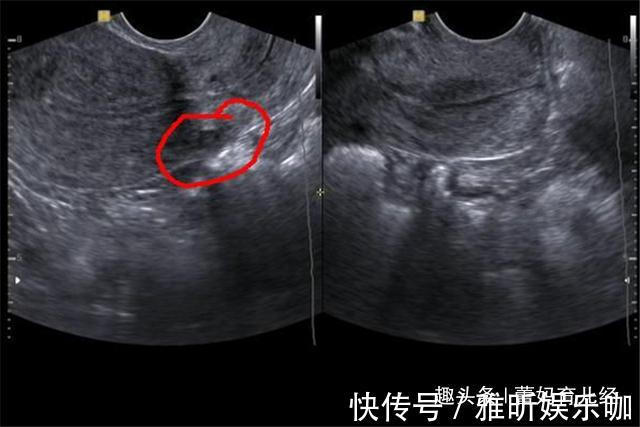弓形虫|女子怀孕7个月,胎儿突然停止胎动?“嘴馋”或成罪魁祸首