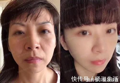 微创 聊一聊除了拉皮手术,微创小切口提升怎么样?多大年纪适合做?