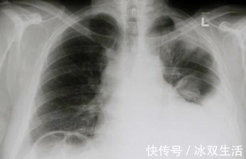 腹水|闻癌色变?可能可怕的不是癌症本身,这些并发症才是真正的“致命凶手”