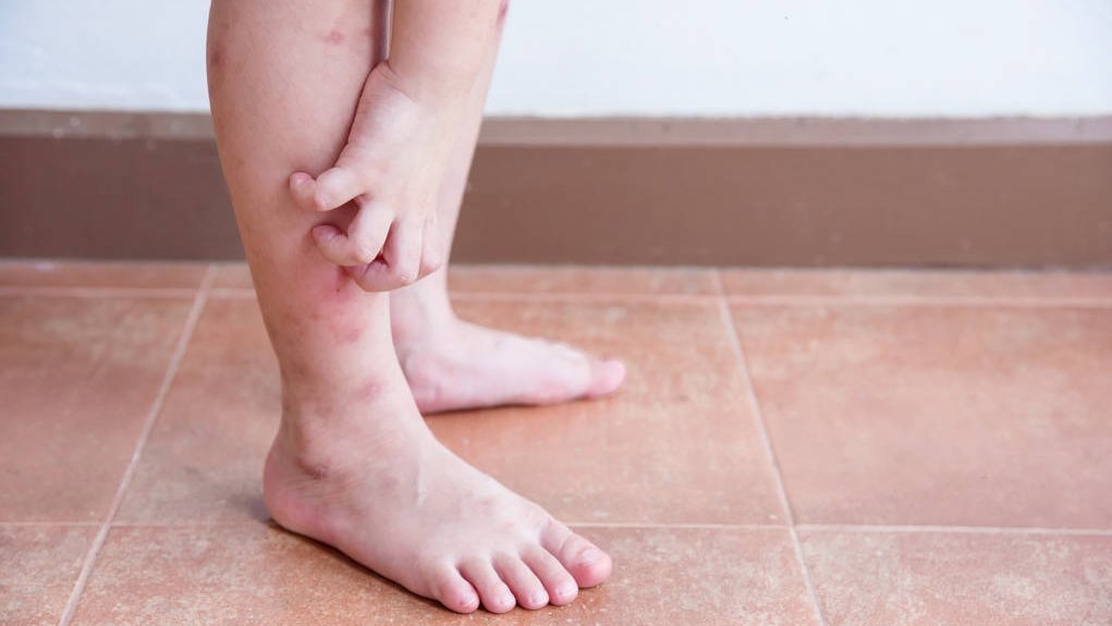 免疫系统|夏天被蚊子扰得不厌其烦?医生教你科学方法,轻松让蚊虫去咬别人