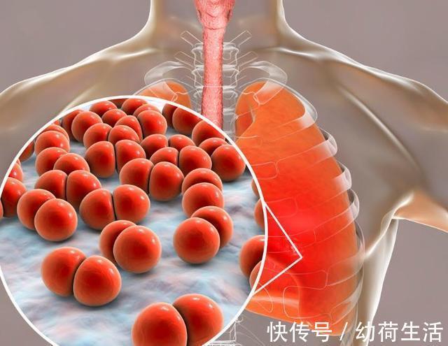 咳嗽|宝宝得了肺炎,你却以为是感冒这些早期症状,就是肺炎前兆!