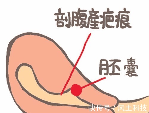 宫内孕|明明是宫内孕,为什么医生说不能要古代女性却没有这个烦恼!