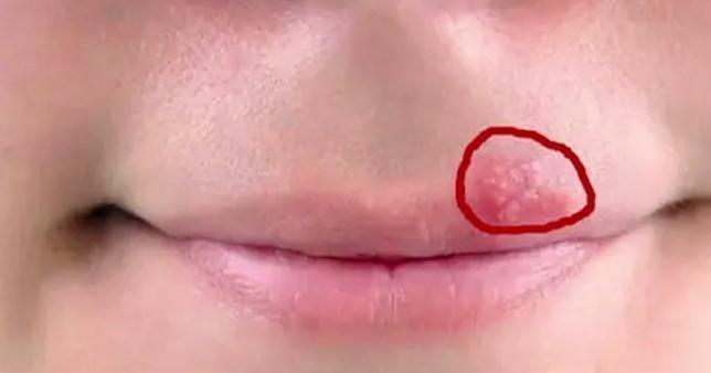 单纯|嘴巴周围时不时出现几个水泡,医生提醒:这不是“上火”,会传染