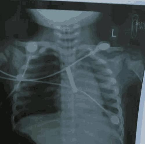 医生|1岁半宝宝突然倒地身亡, 医生竟在体内找到此物, 家长注意了