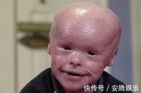 鱼鳞癣|5岁男孩,全身长满“鱼鳞”,父母天天为其刮鳞,大开眼界