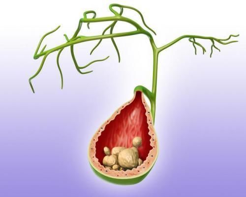 切除|胆囊切除后，是否会影响健康？哪些食物需要忌口？不妨了解下