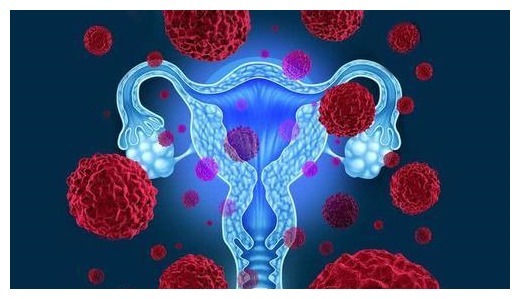 识别|46岁女子感染HPV不自知，认清2个“症状”，助你尽早识别