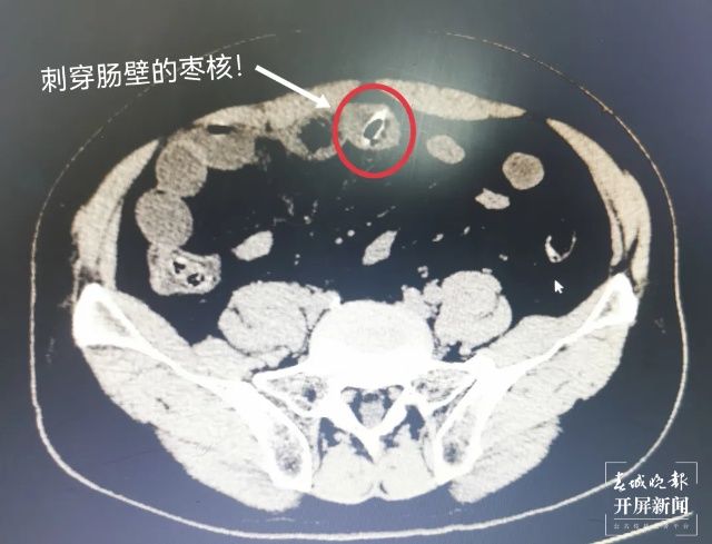 肝胆|7旬老人“囫囵吞枣”险丧命，省三院紧急手术解难题