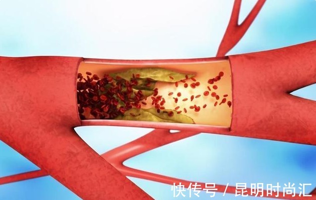 堵塞|血管堵塞的人,脸上会出现5种表现,若没有,恭喜你体内没有血栓