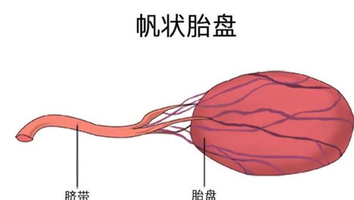 出现帆状胎盘，孕妈们该怎么做？这篇文章告诉你答案