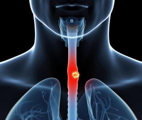 慢性咽炎|因“咽炎”就诊，却查出食管癌！肿瘤医生：出现这些症状需警惕