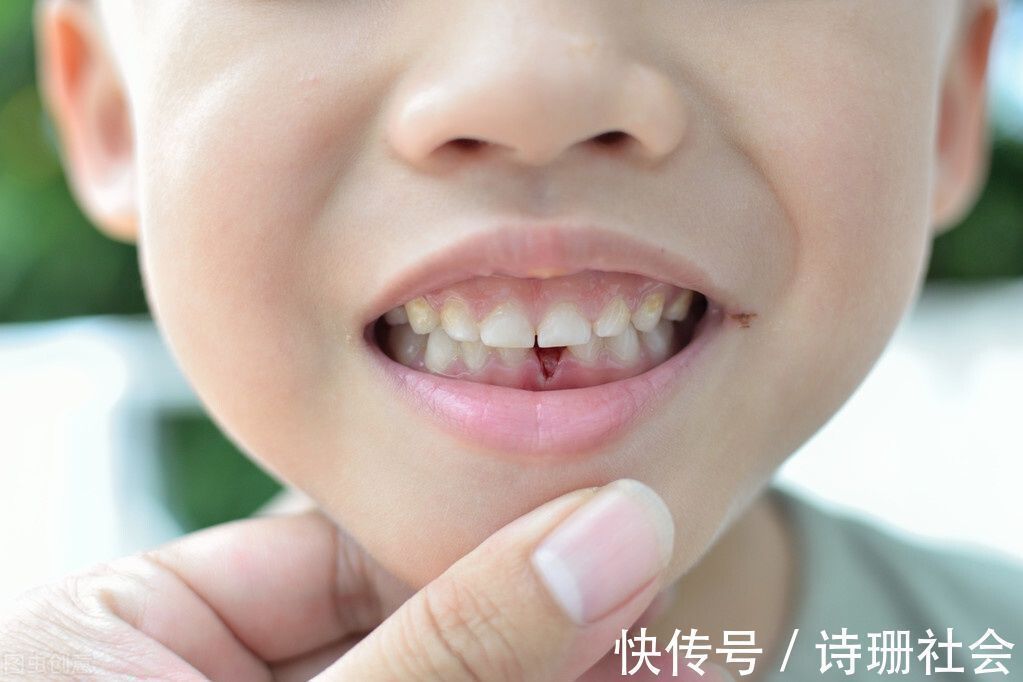 牙胚|孩子长出“双排牙”太难看?是乳牙脱落太晚导致的,需要适当刺激