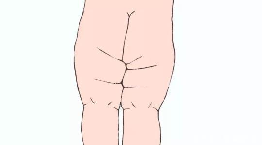 小果|宝宝腿纹不对称跟髋关节发育不良有什么关系,3种情况要注意