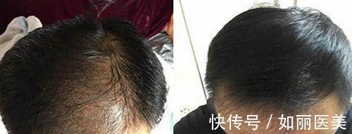 技术 植发技术好不好?植发和微针植发哪个好?优缺点分析