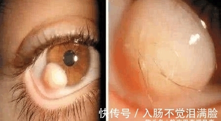 右眼处|直击: 全世界最恐怖的5双“变异”人眼,他的眼会抽烟