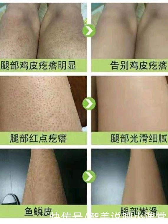 保养品|一招解决“鸡皮肤”