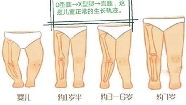 畸形|父母的4种做法，可能导致宝宝骨骼畸形，别大意，不少人犯