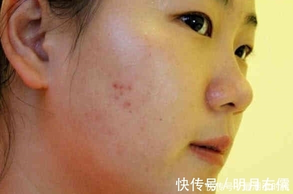 异常|肝火旺的人,一般会有5个异常表现,希望你一个没中