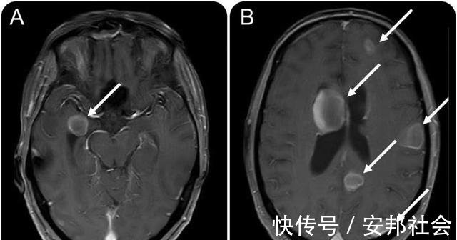 根治性|明明是肺癌早期做了根治性手术，不久就复发转移了，到底什么原因