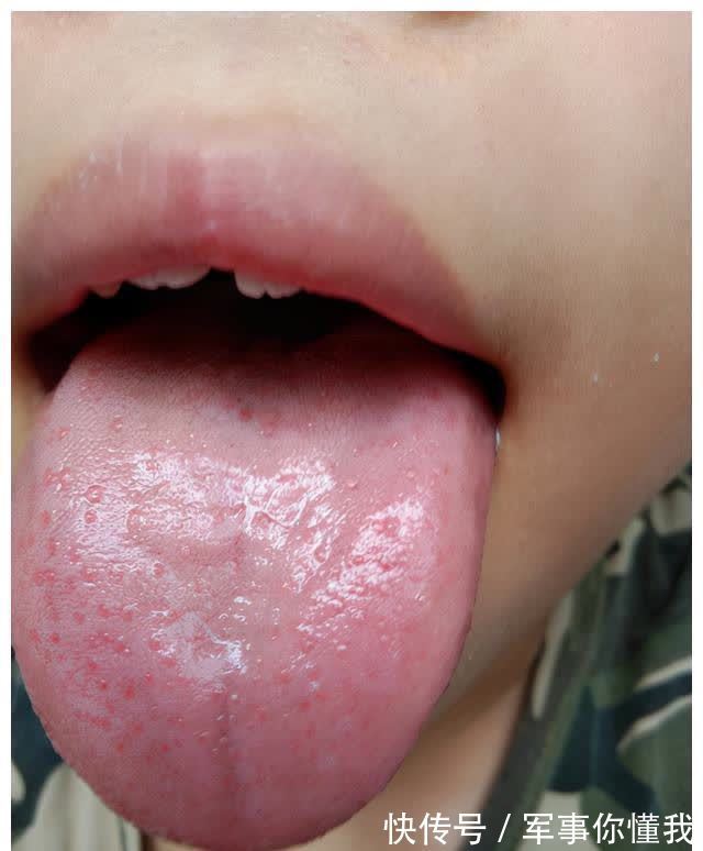 恢复|孩子生病要想恢复得快!一个负责的家长很重要