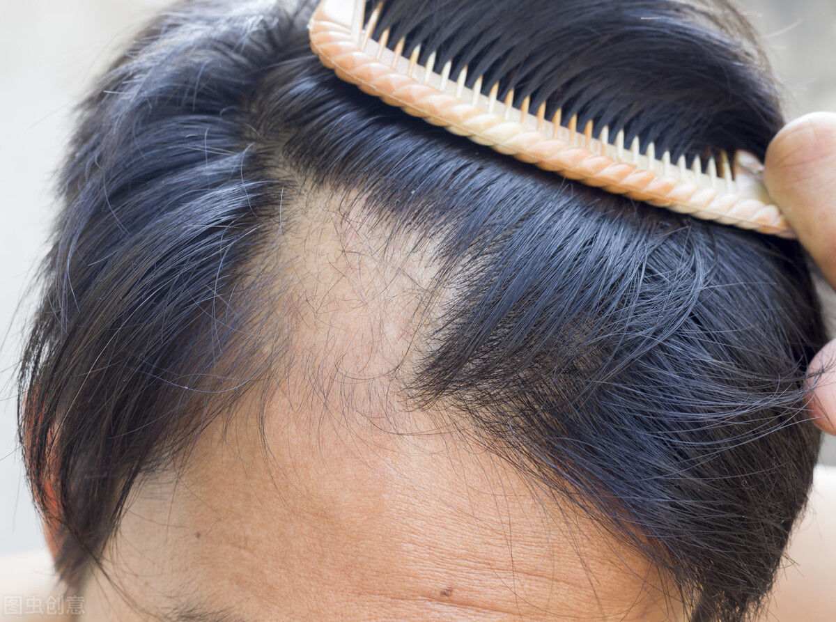 雄激素性脱发|脱发人士必看：拯救发量的N个办法，到底哪个最靠谱？