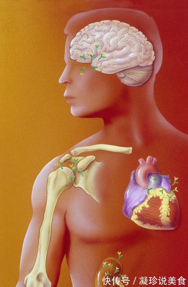 医生|女子咳嗽以为感冒,后天天咯血,医生看到鼻梁上的皮疹差点误诊