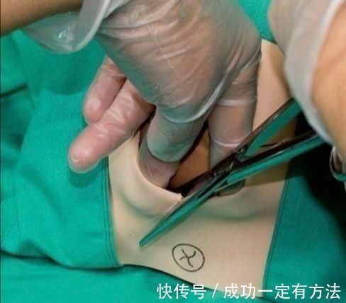 医生|孕妇须知:顺产侧切后,缝针会不会很疼?答案跟你想的不一样