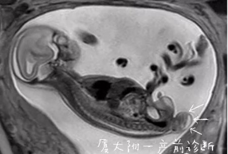 附属第一医院|崩溃！女子怀孕5个月，发现胎儿竟有“尾巴”，医生初步判断...