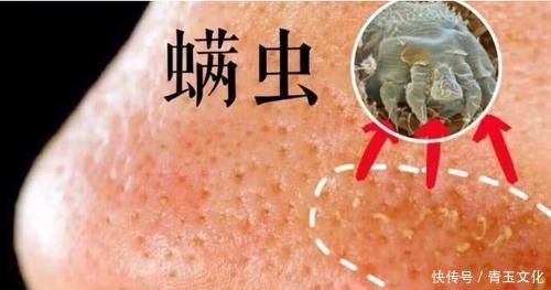 毛孔越来越大，是螨虫把你的脸当成寄宿地，3个方法教你摆脱困扰