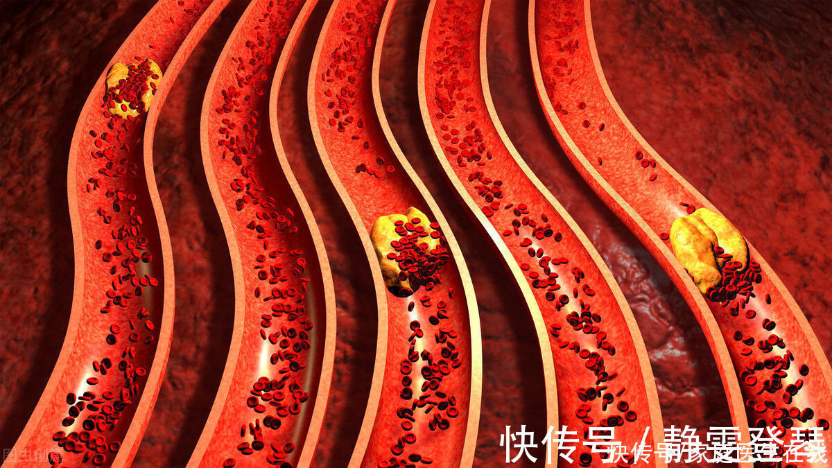 生命时报|血管堵了有怎么样的体验？很危险，3个方法让全身血液流通