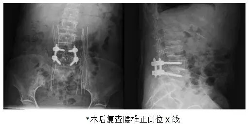 手术|“小切口解决大问题”——微创手术治疗腰椎间盘突出症