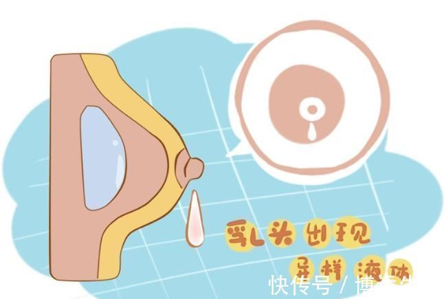 女性|女性乳腺癌发作前,身体会发出这6种异常信号,越早发现越好