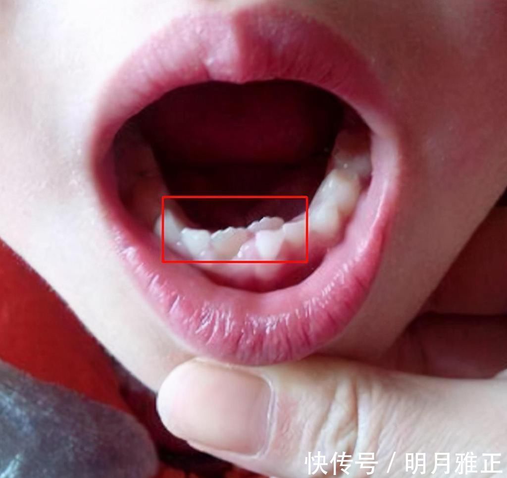 智齿|6岁男娃长“双层牙”,老人的“坏习惯”害了娃,你家有这习惯吗