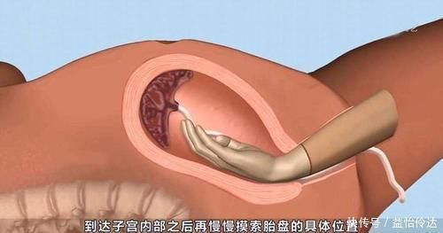 产后抑郁|产妇生完孩子半小时,医生再次伸手进去,产妇大怒却被回怼为你好