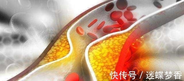 凝血因子|中风的“罪魁祸首”是血栓, 记牢两个字血栓不上身