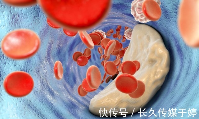 营养物质|大鱼大肉并不是高血脂的源头，医生提醒：3物才是劝你管住嘴