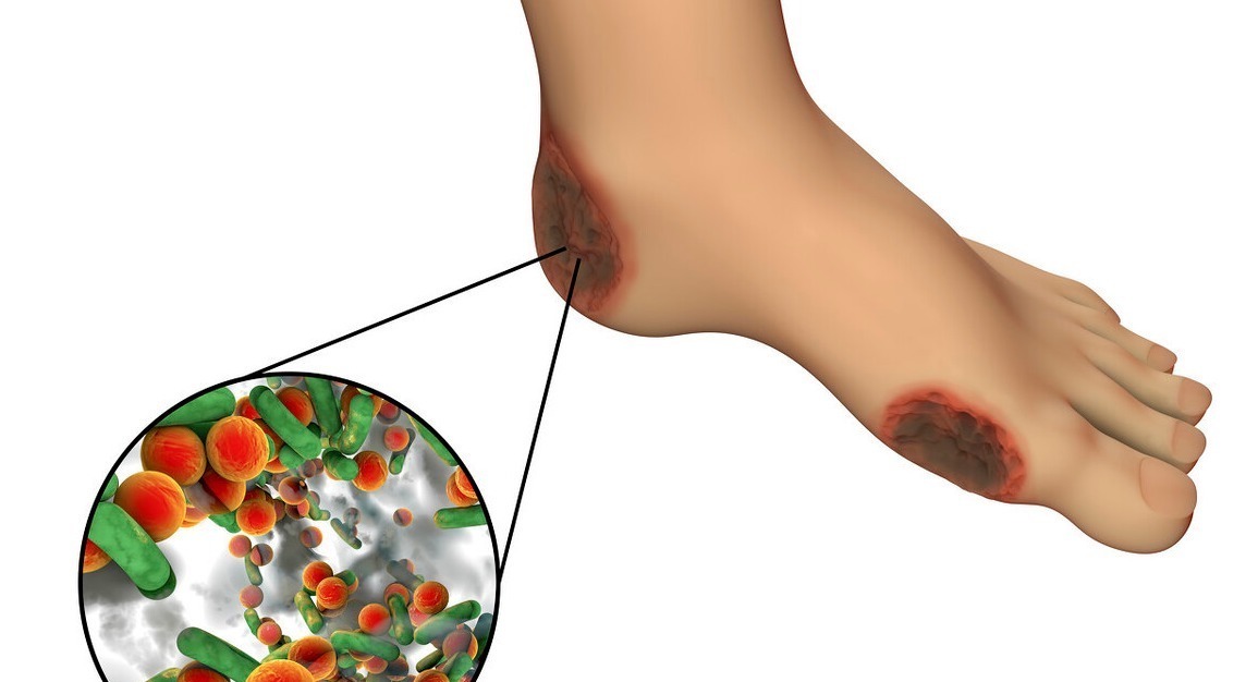 间歇性跛行|糖尿病足是每个糖友的“噩梦”!医生提醒出现4个症状就该警惕