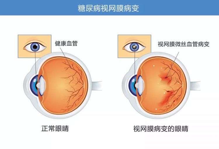 视网膜病变|“糖网”不是“网”，严重可致盲！