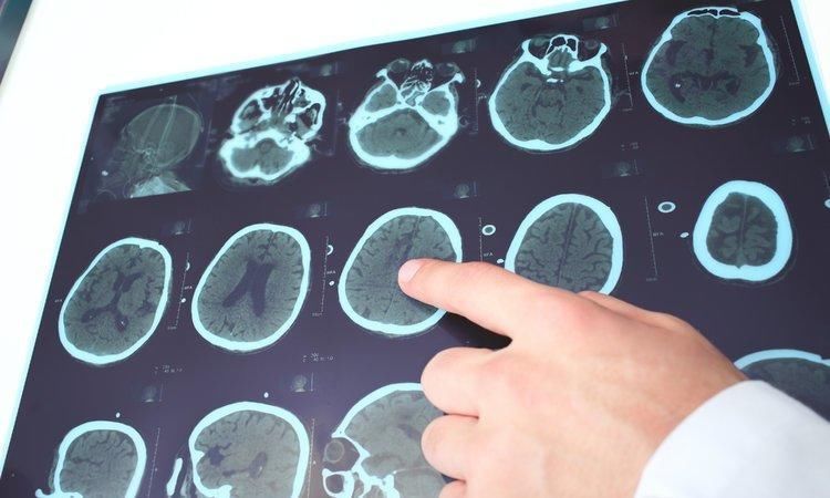 常放屁是肠癌的“暗示”吗肿瘤科医生说3个症状才是肠癌信号