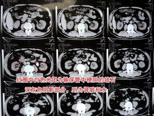 双侧|男子常年饮浓茶如同“茶罐子”，突发腰胀才知竟患结石