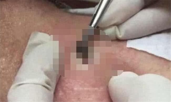 儿子|宝宝后背长颗“黑痣”,一碰就痛,医生取出的东西妈妈无法淡定