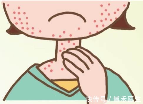 抗过敏药|螃蟹过敏多久能好