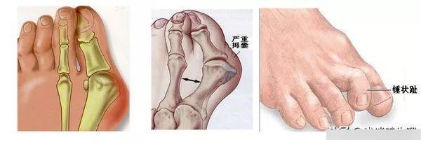 糖尿病患者|糖尿病者，一旦手脚有四种变化，并发症来了，再拖下去就是肾衰竭