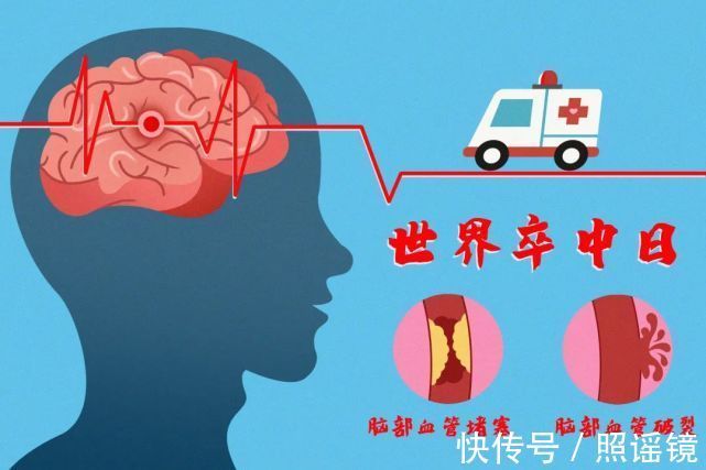 脑血管疾病|脑卒中是老人得的病？还真不是！