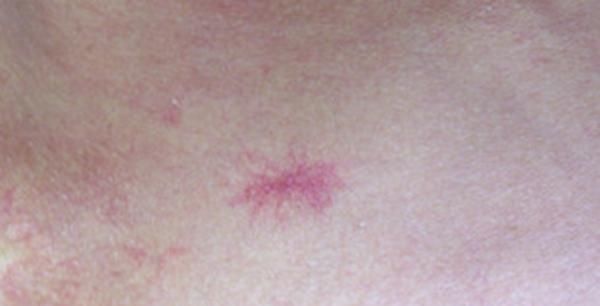 尽早|因皮肤长小红点,查出肝癌,医生:皮肤若出现3种异常,尽早查肝