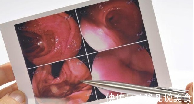 肠梗阻|17岁男生查出肠癌晚期,丧失手术机会!父母还以为仅仅是吃坏肚子