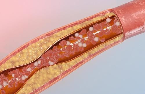 小事|血脂“发物”是面条？想要降脂，做好这几件小事，或是关键