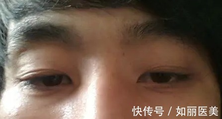 医院 做双眼皮手术年纪大了以后会变成什么模样?