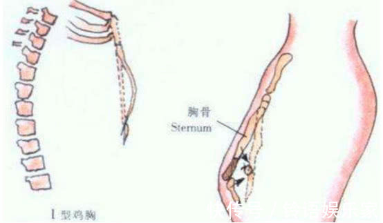 胸骨|为什么患上“鸡胸”的宝宝越来越多做父母的责任很大啊