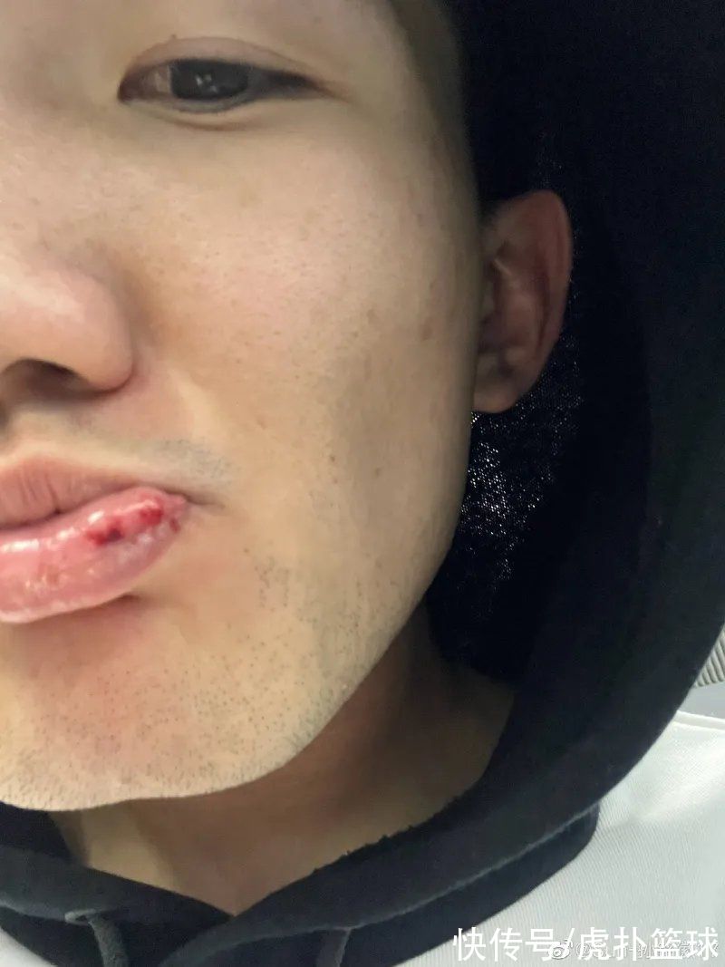 更博|孙铭徽更博：这嘴咬不上张不开咋整